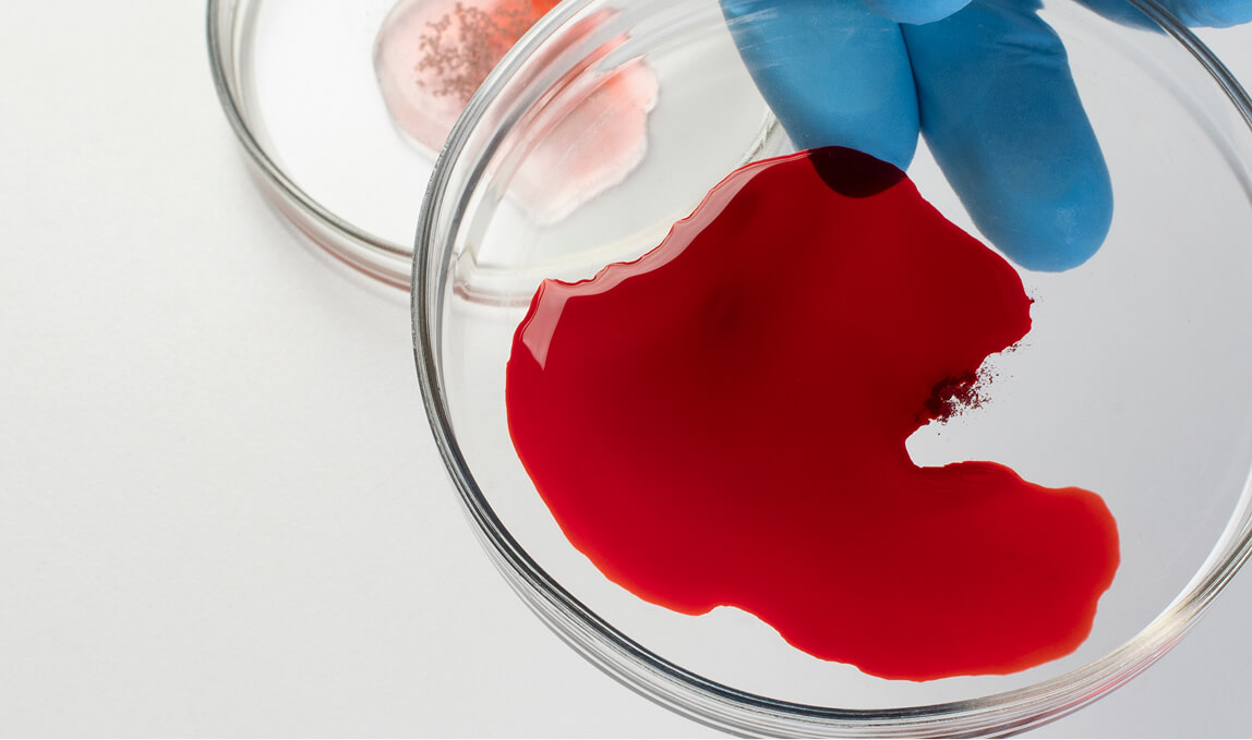 Lab technician in blue gloves handling a petri dish with a blood sample for Hemophilia A coagulation disorder analysis