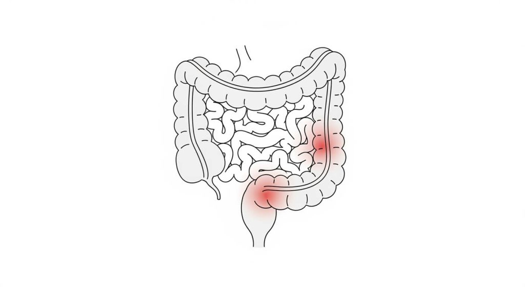 inflammatory bowel disease diagram highlighting colon and intestine inflammation