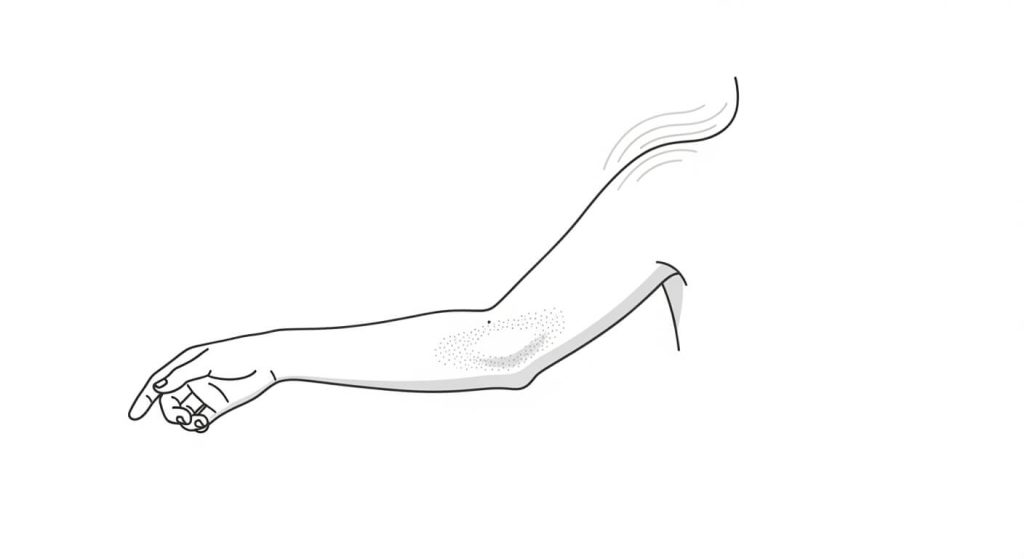 Psoriasis illustration showing an itchy scaly plaque on the elbow and mild scalp involvement