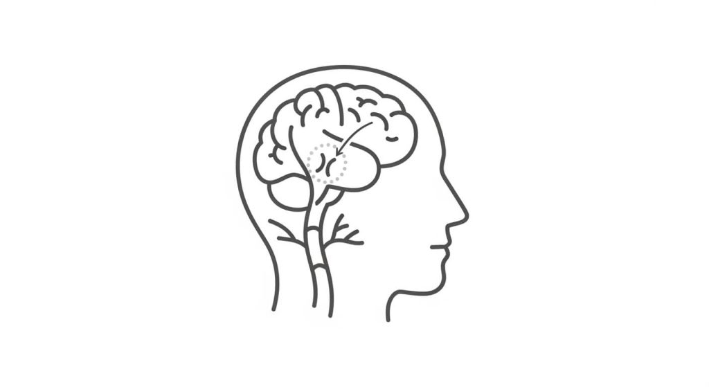 Stroke (Acute Ischemic Stroke) illustration showing a blocked brain artery and reduced blood flow