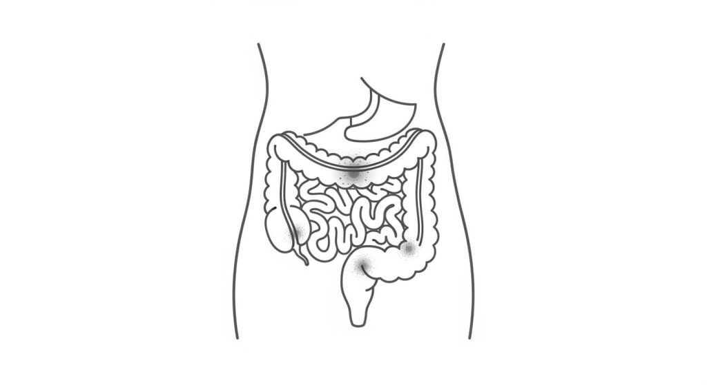 Ulcerative colitis illustration showing inflammation and ulcers in the colon and rectum